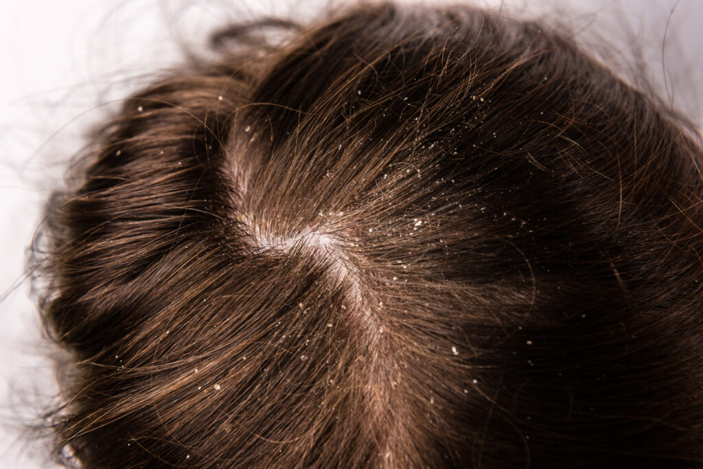 Why a Healthy Scalp Matters for Your Hair Growth! Cover Image PT1 242323